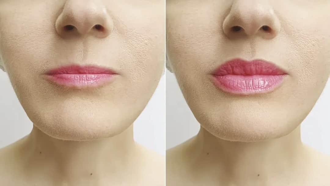 Ile kwasu hialuronowego w usta? Objętości, efekty, cena, trwałość