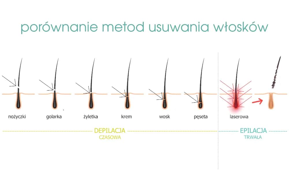 Elektroepilacja: Jedyna trwała depilacja dla każdego włosa?