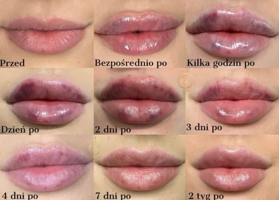 Powiększanie ust: Jaki kwas hialuronowy wybrać? Ekspert radzi