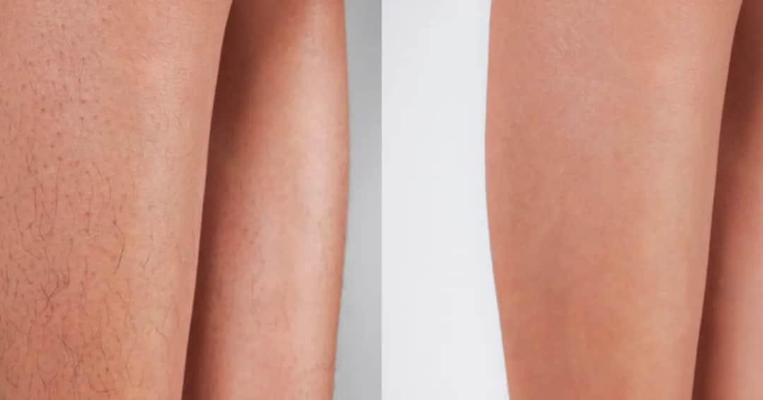 Depilacja laserowa: na ile lat gładka skóra? Co musisz wiedzieć