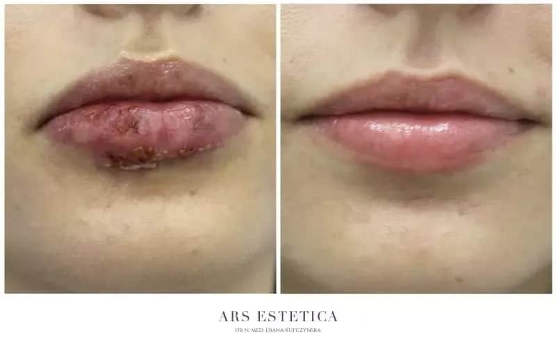 Ulga po powiększaniu ust: Ból, obrzęk? Ekspert radzi, co robić.